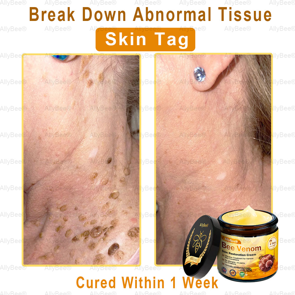 🐝🎁AllyBee® Only 5 Jars Left! 50% OFF – Clear Warts & Moles in 1-4 Weeks! Fast results, gentle on skin. 180-day guarantee. Don’t miss out!