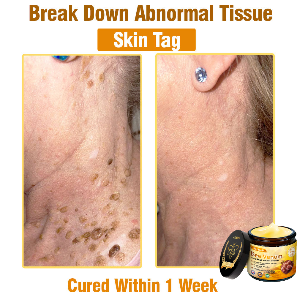 💐🌟💐 AllyBee® Last Chance! 70% OFF Skin Repair Cream,Fade scars, smooth skin, and glow naturally. Free air shipping & risk-free for 180 days.