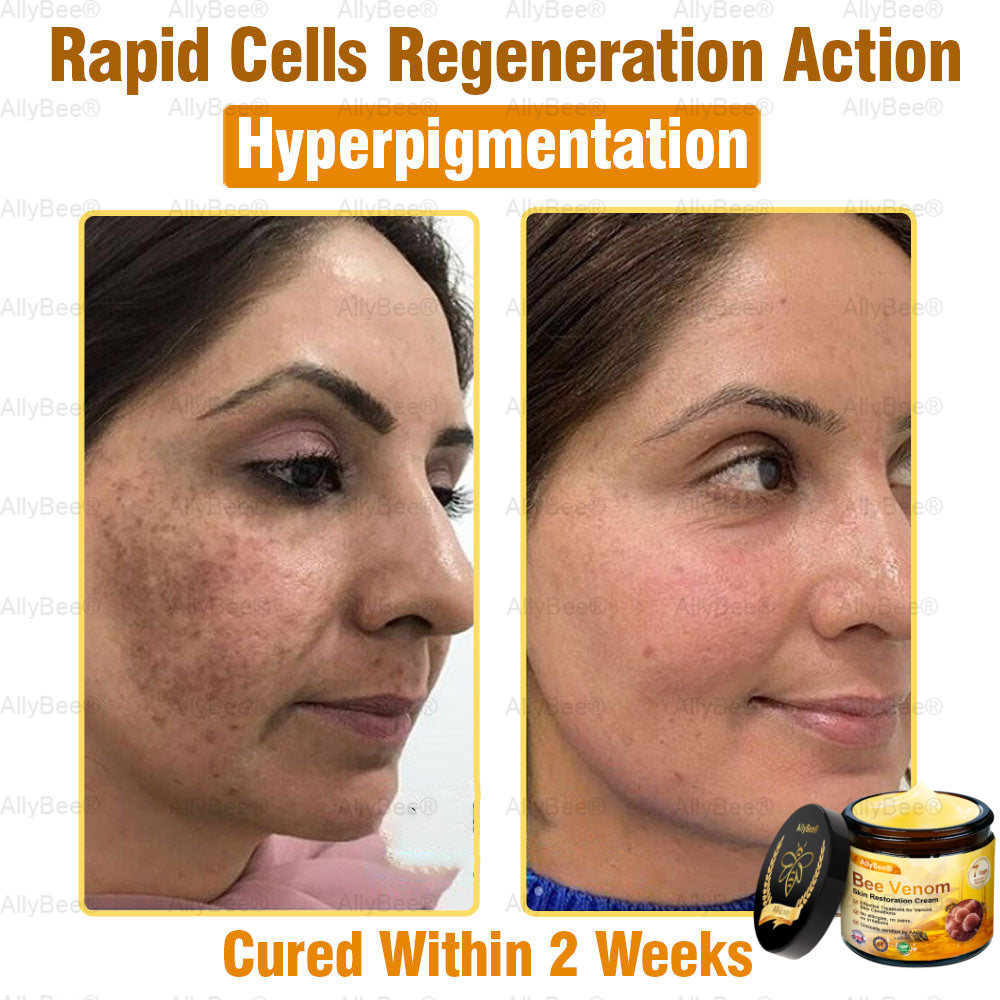 💐🌟💐 AllyBee® Last Chance! 70% OFF Skin Repair Cream,Fade scars, smooth skin, and glow naturally. Free air shipping & risk-free for 180 days.